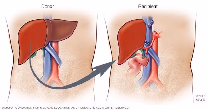 La transplantation d'organes au Vietnam à l'ère de la médecine de pointe