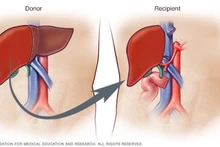 La transplantation d'organes au Vietnam à l'ère de la médecine de pointe