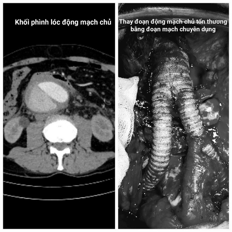 Images des lésions et des techniques chirurgicales de traitement pour les patients. Photo : bachmai.gov.vn dong-mach-ndel.jpg