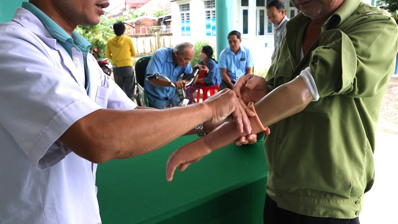 L’ajustement de prothèses et d’orthèses est une étape dans le processus de fourniture d’appareils d’assistance aux personnes handicapées dans trois provinces bénéficiaires du projet Inclusion 1. Photo : thoidai.