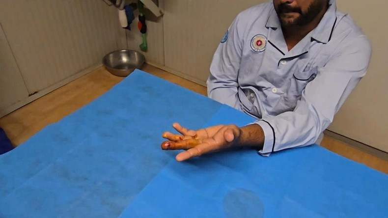 Quatre jours après l’intervention, l’irrigation sanguine, la mobilité et la sensibilité du doigt blessé s’étaient nettement améliorées. Photo : VOV.