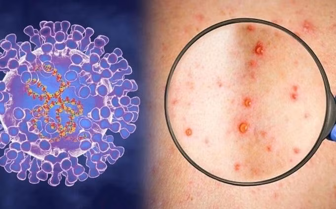 La variole du singe. Photo : dantri.com.vn