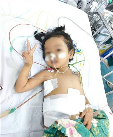 Huit jours après la greffe, l’enfant a pu manger par voie orale sans soutien et se rétablit progressivement. Photo : VNA